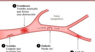 Trombosis o embolia