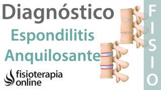 Espondilitis anquilosante - Qué es, diagnóstico y tratamiento