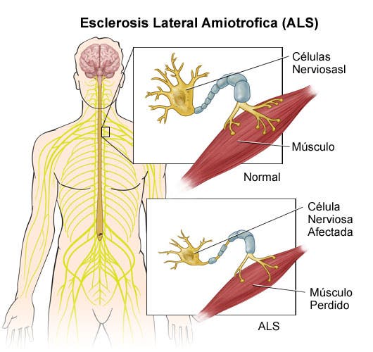 desarrollo esclerosis amiotrofica