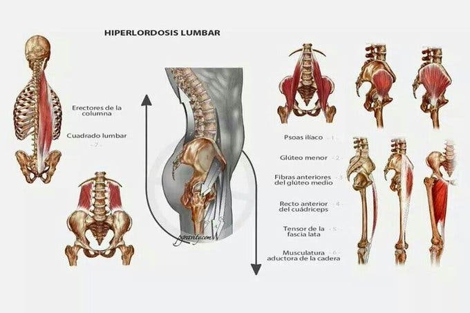 hiperlordosis lumbar
