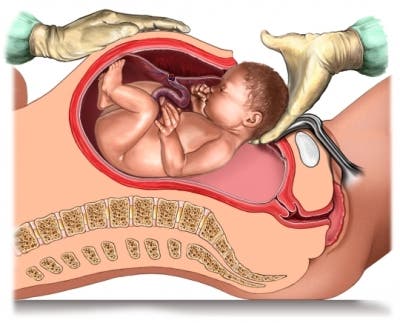 parto abdominal o cesárea