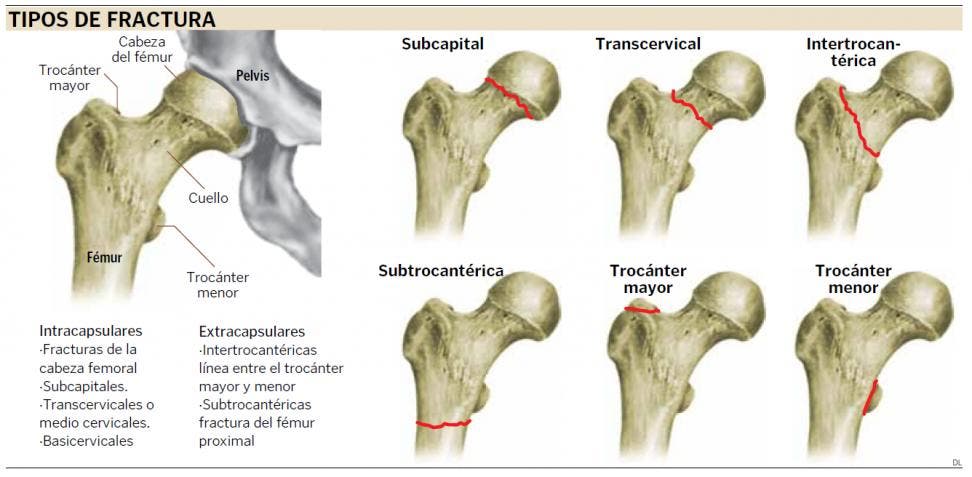 tipos de fractura de cadera