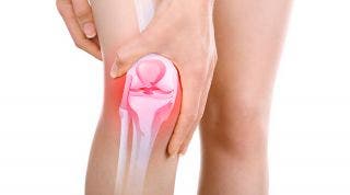 ¿Qué es una bursitis de rodilla? Causas, diagnóstico y tratamiento en fisioterapia y medicina