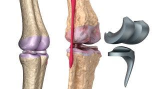 Rehabilitación de una prótesis de rodilla o artroplastia de rodilla. Consejos, ejercicios y fases de tratamiento