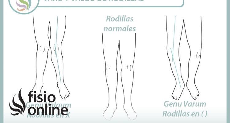 Rodillas varas o valgas. Dos alteraciones posturales y dos ejercicios para trabajarlas