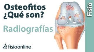 Osteofitos - Qué son y cómo se ven en radiografías y TAC