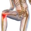Tratamiento fisioterápico de la gonartrosis o artrosis de rodilla