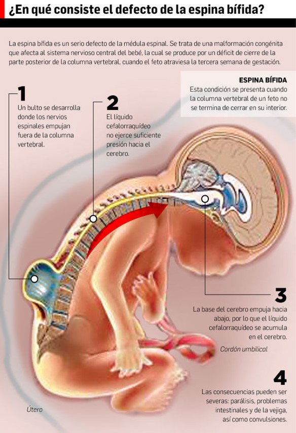 Cómo se desarrolla la espina bífida