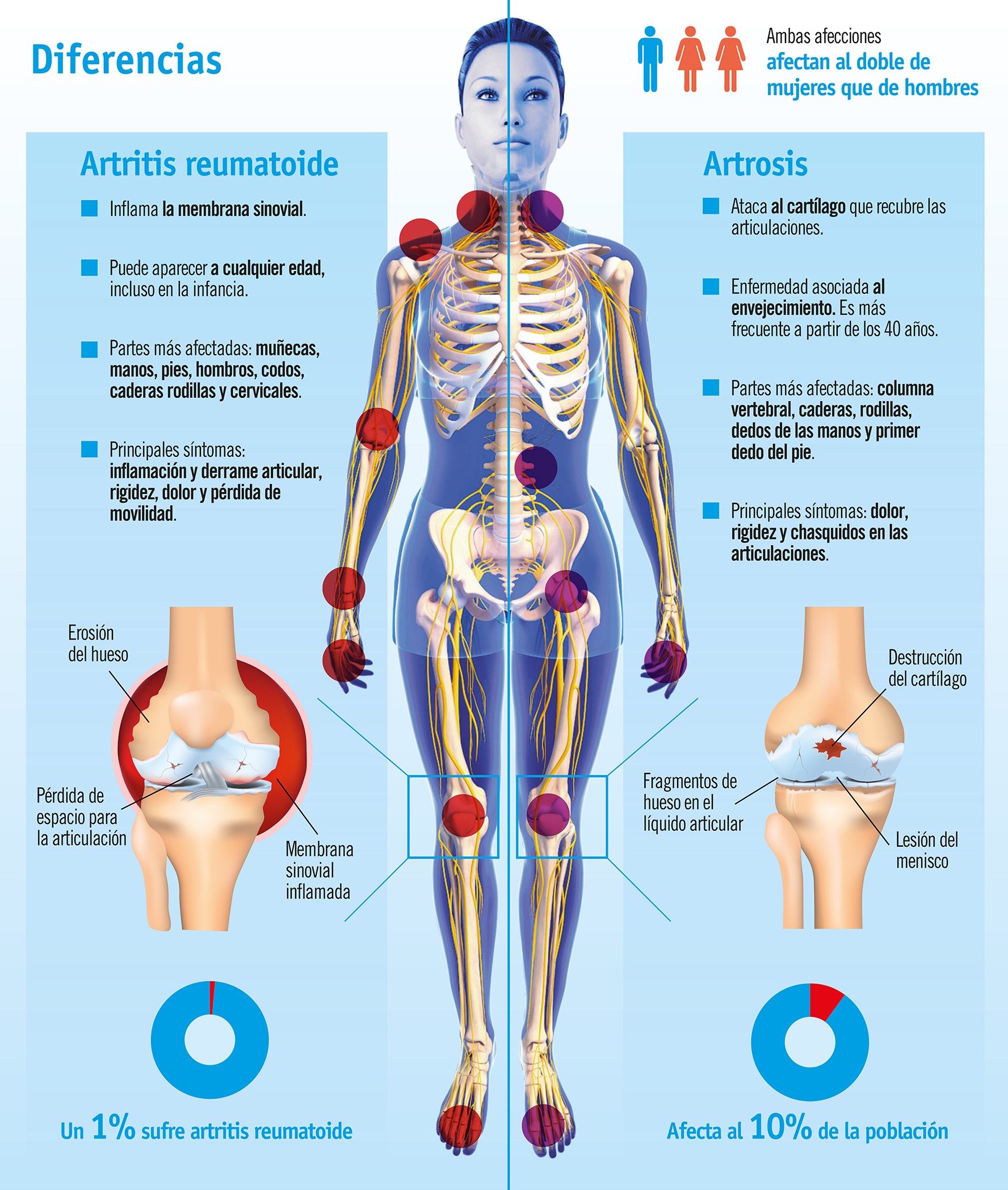 Diferencia entre artritis reumatoide y artrosis