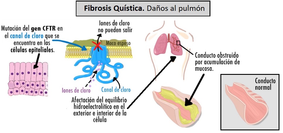 daños en el pulmón por la fibrosis quística