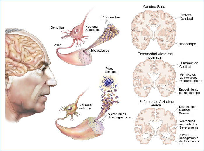 Qué parte del cerebro se ve afectado por el Alzheimer