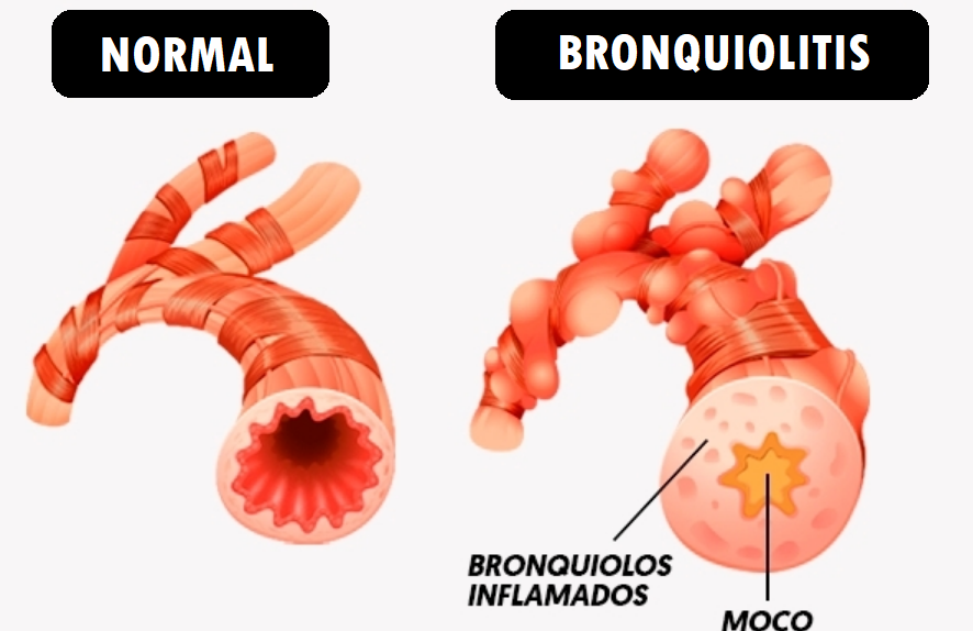 bronquiolos sanos y con bronquiolitis
