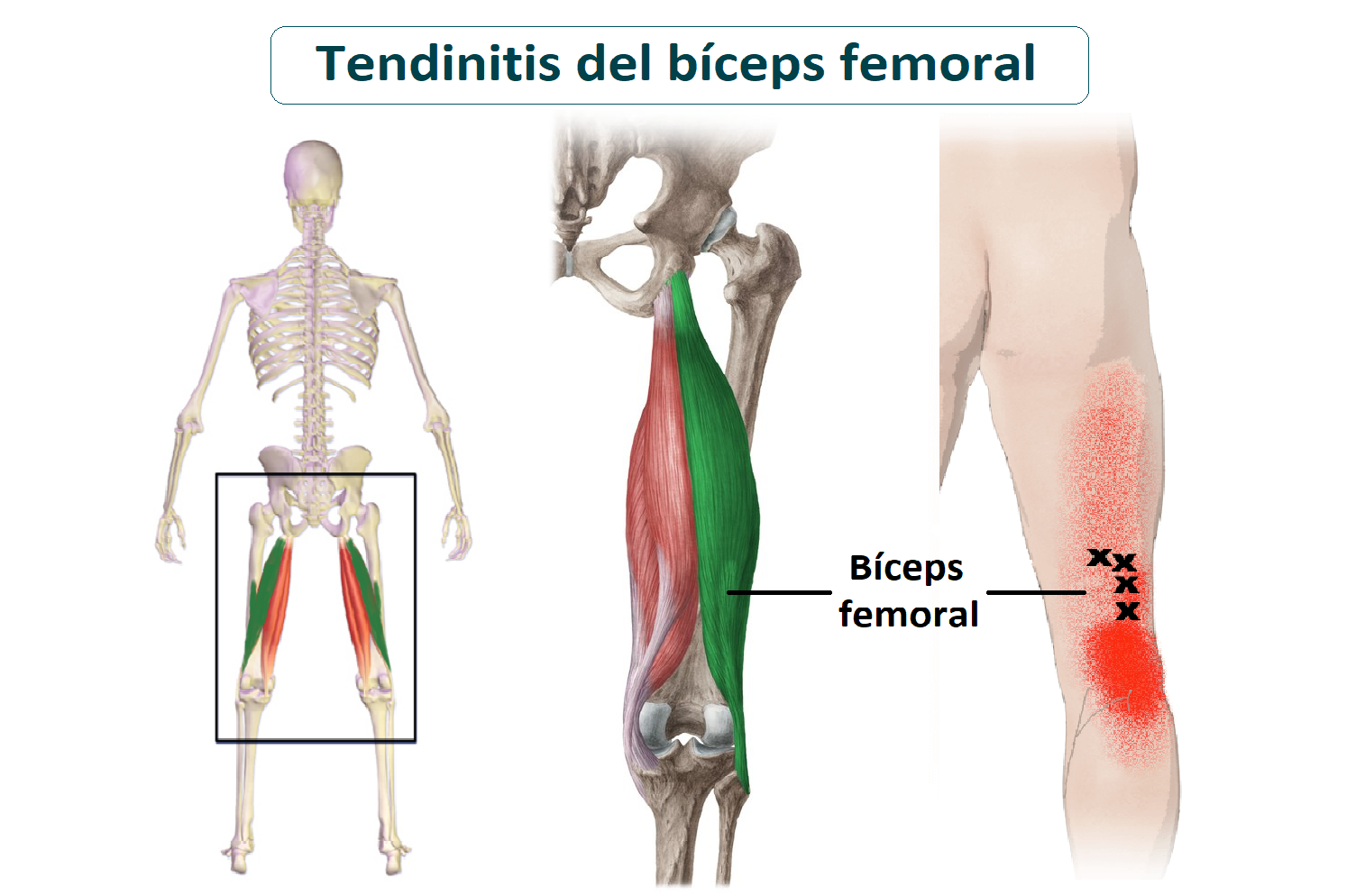 anatomia tendinitis de biceps femoral