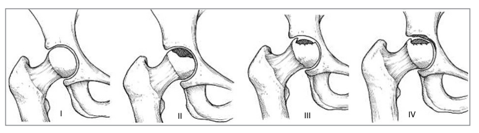 etapas de la necrosis avascular de la cadera