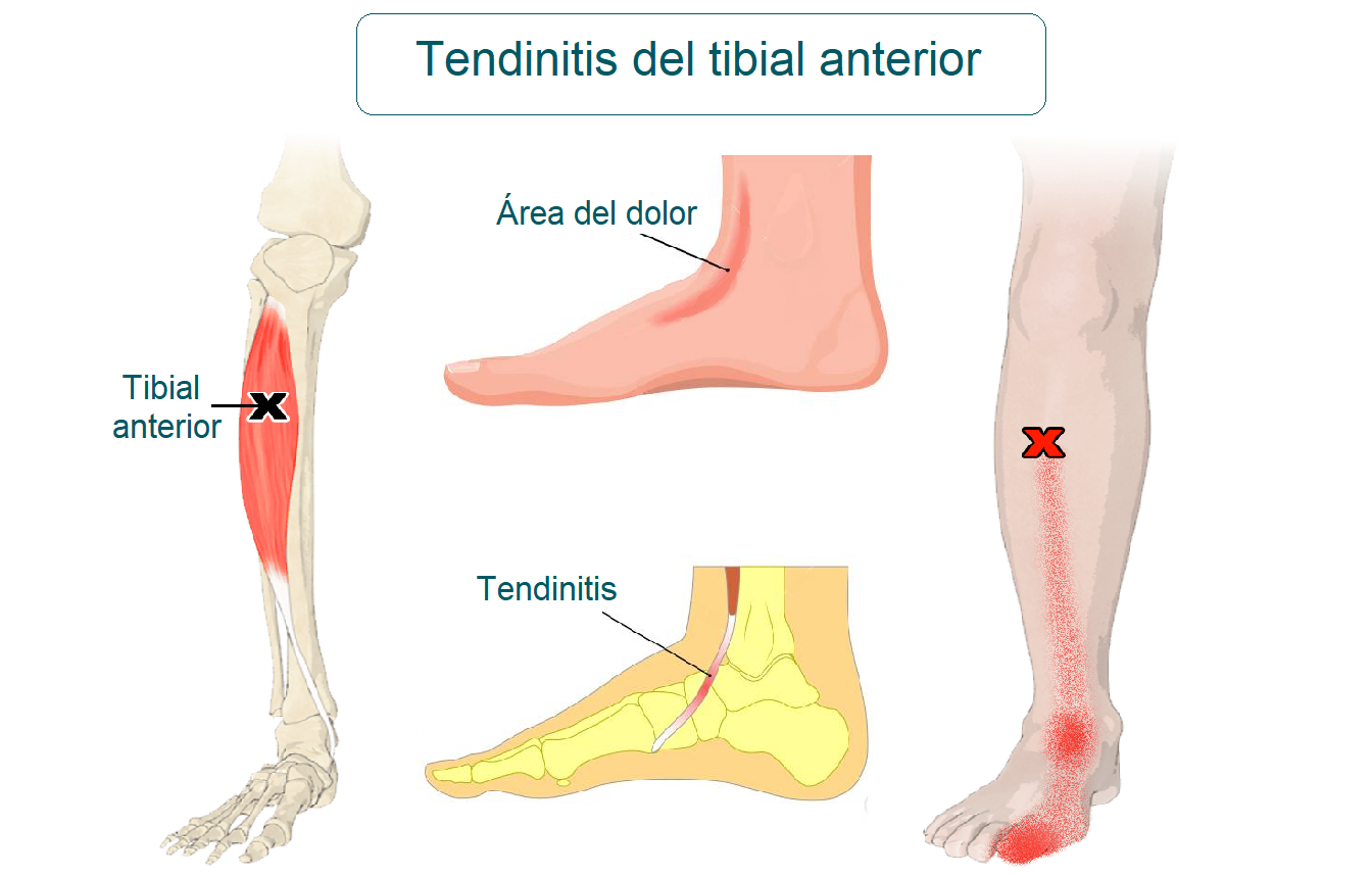 tendinitis de tibial anterior