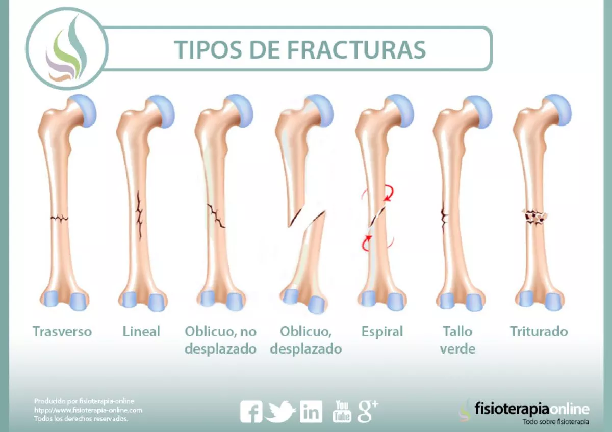 Tipos de fracturas